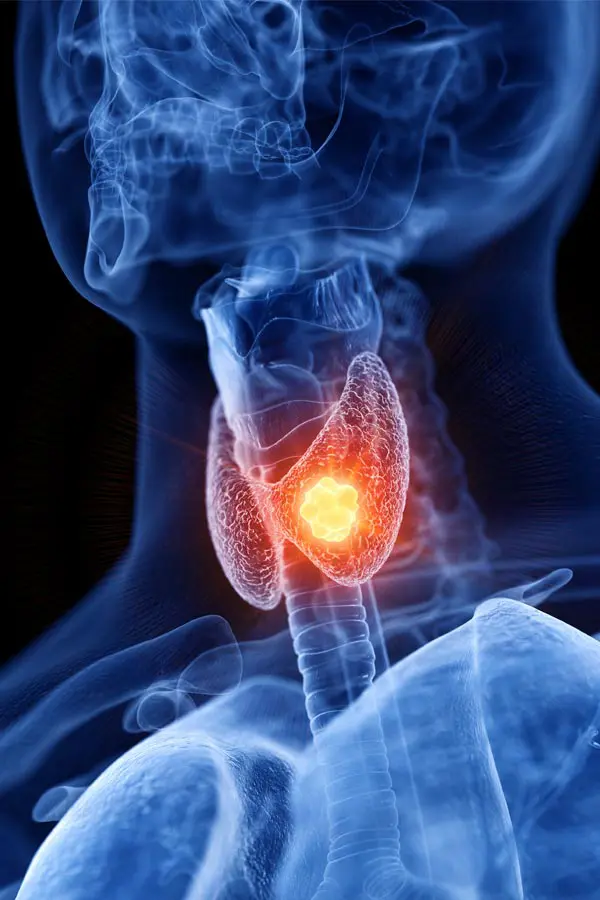 Thyroid-Imbalance-Treatment A 3D illustration of an x-ray of a human neck, highlighting the thyroid. Get help with thyroid imbalance from Scott Gulinson, MD, FACOG in Phoenix.